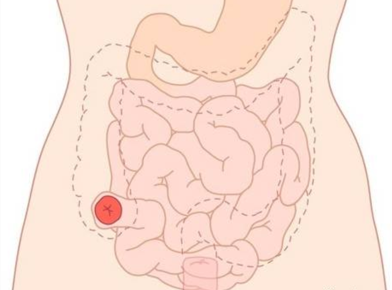 Phẫu thuật và chăm sóc hậu môn nhân tạo: Những điều cần biết 